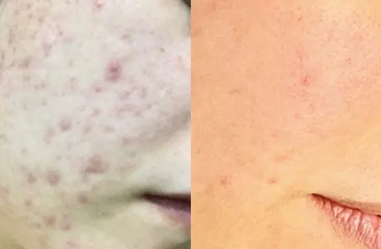 a close up of a tattoo on his head